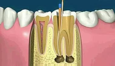 牙齿"杀"神经是什么?