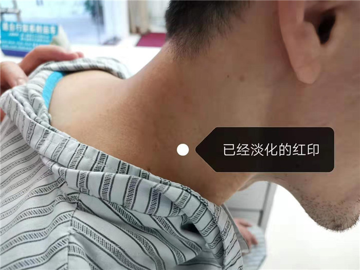在家门口颈部推拿和刮痧理疗,引发颈动脉夹层,36岁男子中风