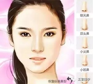 3,驼峰鼻驼峰鼻相对西方人较多,但东方人也有,不仅影响美观,还会削弱