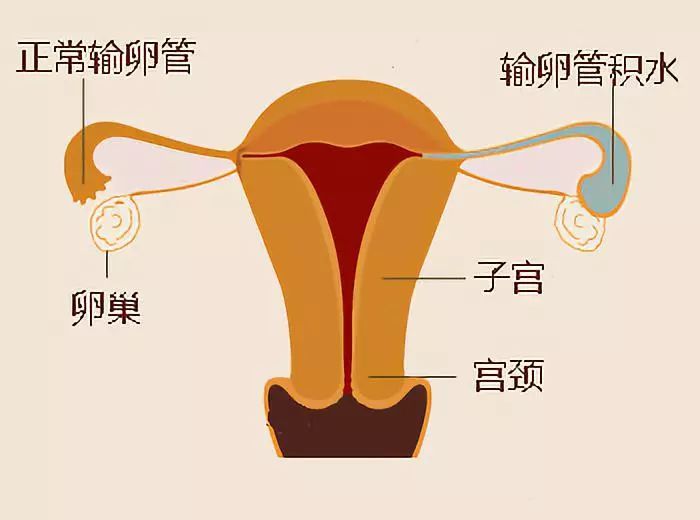 输卵管积水往往是因为炎症影响,输卵管远端比如伞端粘膜破坏,粘连闭锁