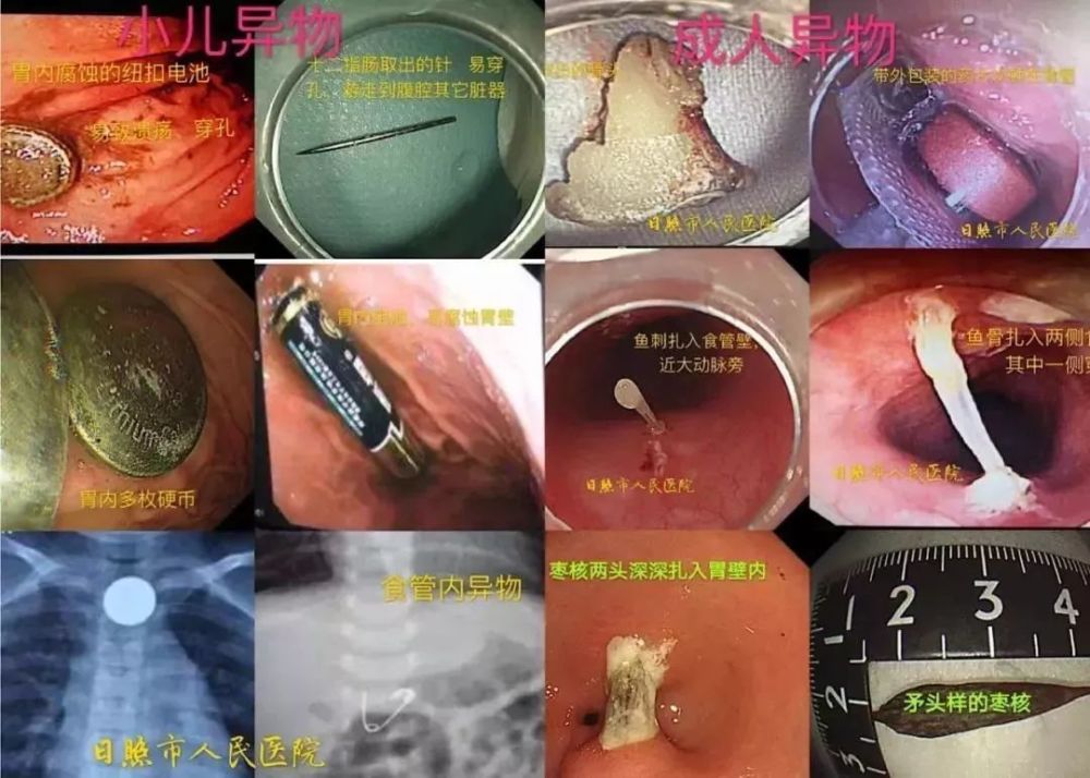 发现消化道异物这样办