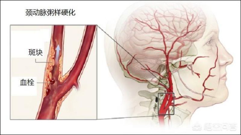 动脉粥样硬化是全身性,终生性疾病