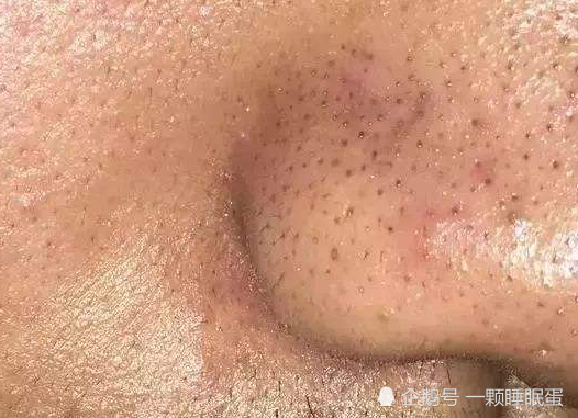 女生鼻子上全是黑乎乎"黑头?千万别手挤,日常简单3招即可