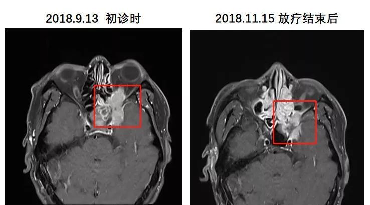 (最大截面2*3cm),考虑恶性改变 诊断 鼻咽癌 ct4n2m0 iva 期 副鼻窦炎