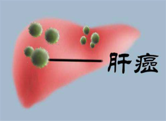肿瘤科医生:"肝癌"来临时基本都有3个"迹象",一旦发现