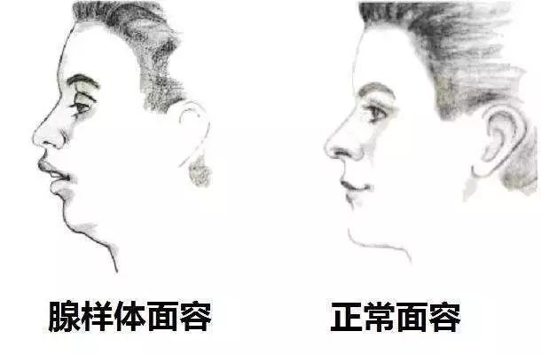 用鼻呼吸的面貌是正常的,但是一旦长期用嘴呼吸就会变成腺样体面容.