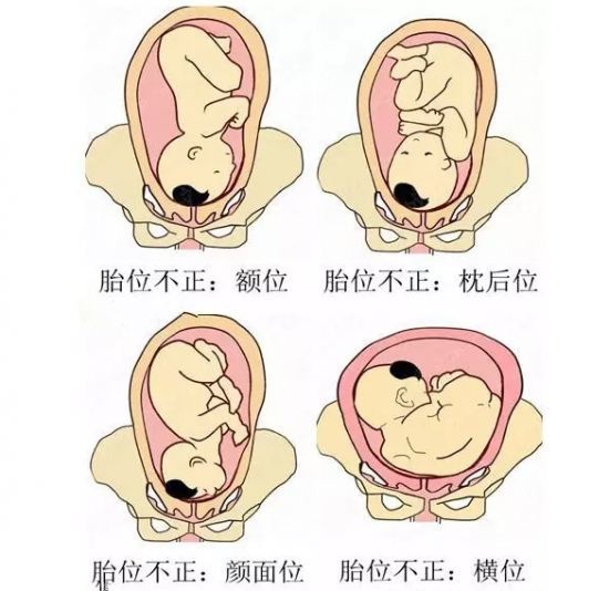 枕后位胎儿面向孕妇的腹部,在腹部前方可触及胎儿肢体;枕横位胎儿面