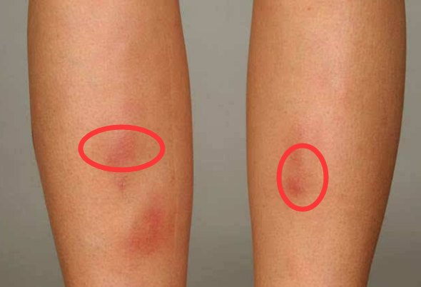 其实,皮肤出现红斑有可能是湿疹,皮炎或者红斑狼疮的问题.
