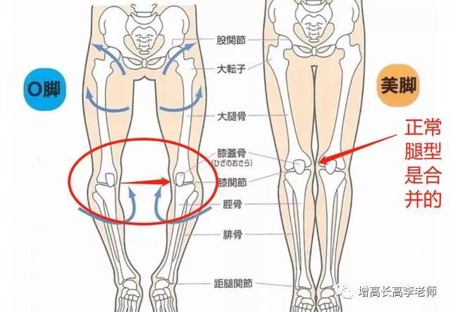 因为o型腿小腿间的缝隙一定是大于膝关节内侧的缝隙的