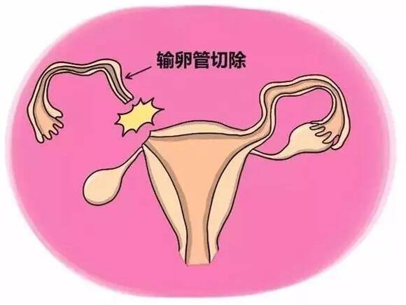 输卵管切除后还能做试管婴儿吗?