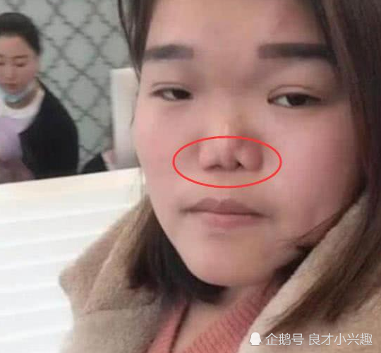 教你3招,轻松逆袭"水滴鼻"