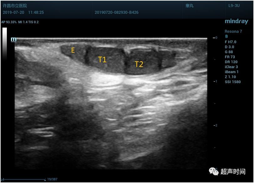 纵切面左侧阴囊内可见两个睾丸回声(t1 和 t2),体积偏小,内部