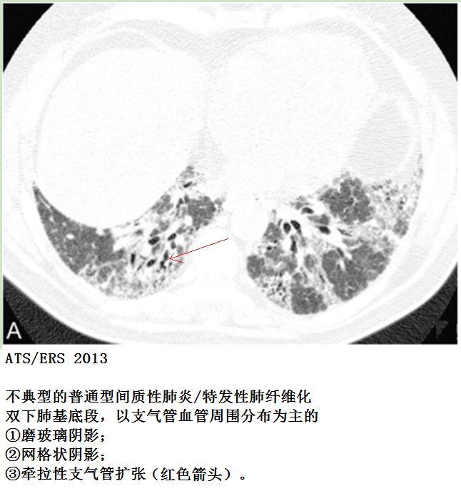 ▎ 特发性肺纤维化