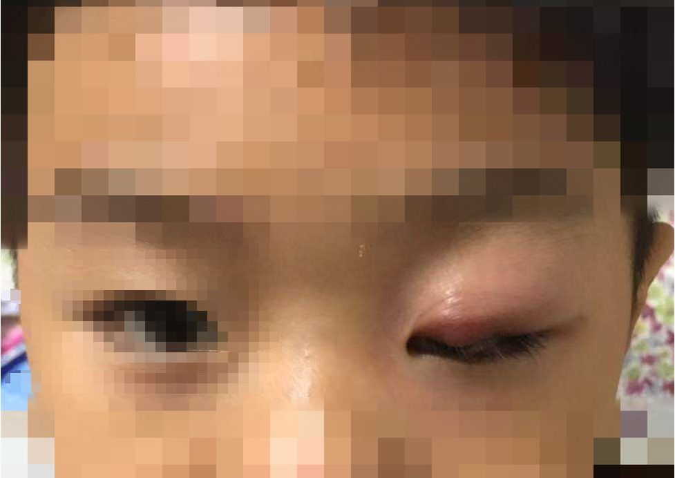 武汉男童眼睛皮上长小包俩月不退 医院一查需要手术
