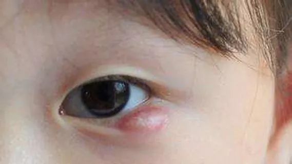 武汉男童眼睛皮上长小包俩月不退 医院一查需要手术