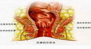 周皮肤相通的肉芽肿性管道,主要侵犯肛管,很少涉及直肠,故常称为肛瘘