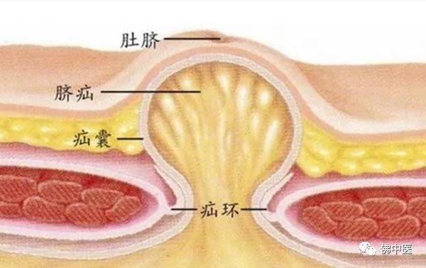 在临床中,常表现为难复性疝,胀痛,包快不能完全回纳;嵌顿性疝,包块