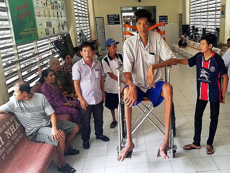 越南男子17岁得巨人症,身高达到2米57,最终因病35岁就