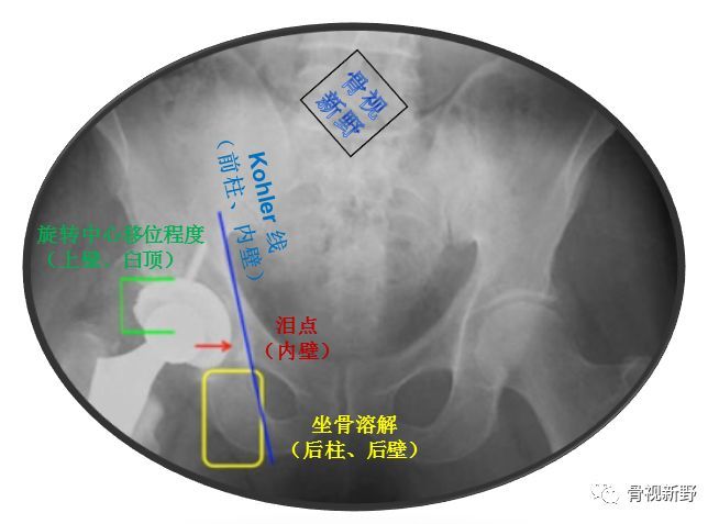 髋臼骨缺损的paprosky分型及其翻修处理原则