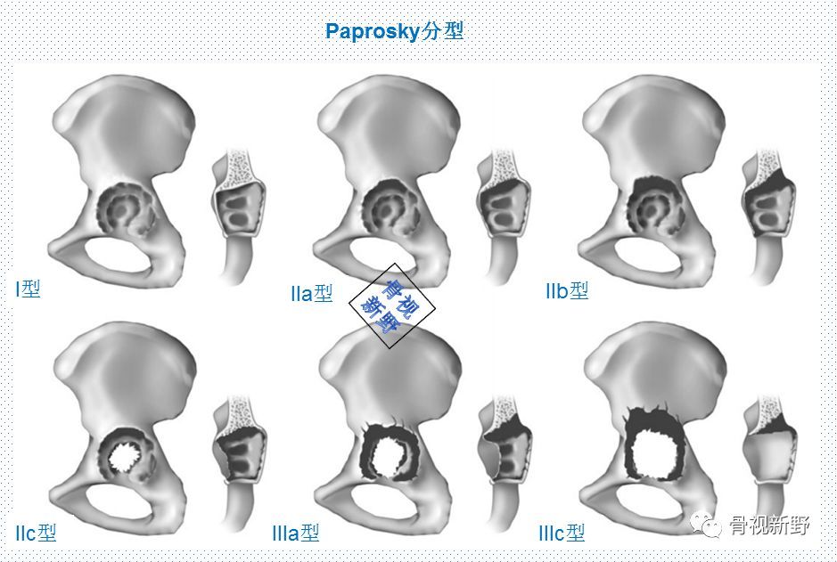髋臼骨缺损的paprosky分型及其翻修处理原则