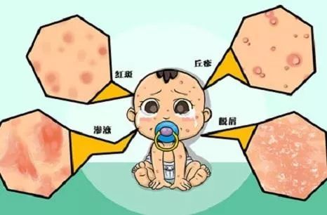 宝宝湿疹怎么办?搞清这一 点,就能轻松应对!