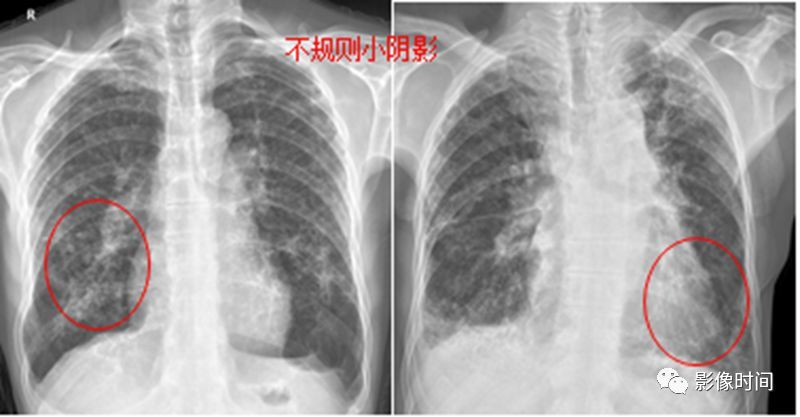 上肺区,常对称出现,典型呈「八字样」改变,部分可见点状钙化,矽肺多见