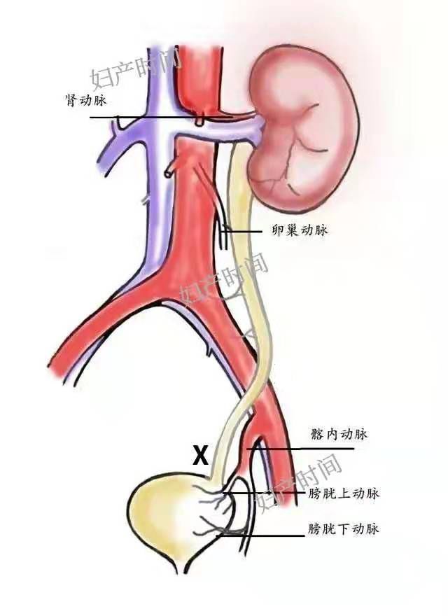 剖宫产后双侧腰痛,这个原因不可忽视!