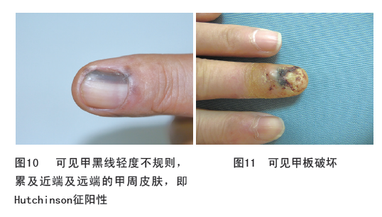 体内有癌,指甲先知?医生忠告:若指甲长这样,警惕是癌变的征兆