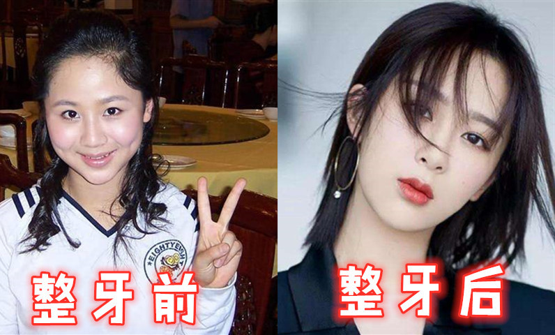 整牙前vs整牙后杨幂还好杨紫还好看到星女郎的她显老十岁