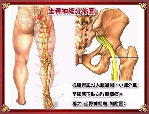 (4)l4-5椎间盘突出症的定位诊断要点 l4-5椎间盘突出压迫l5神经根.