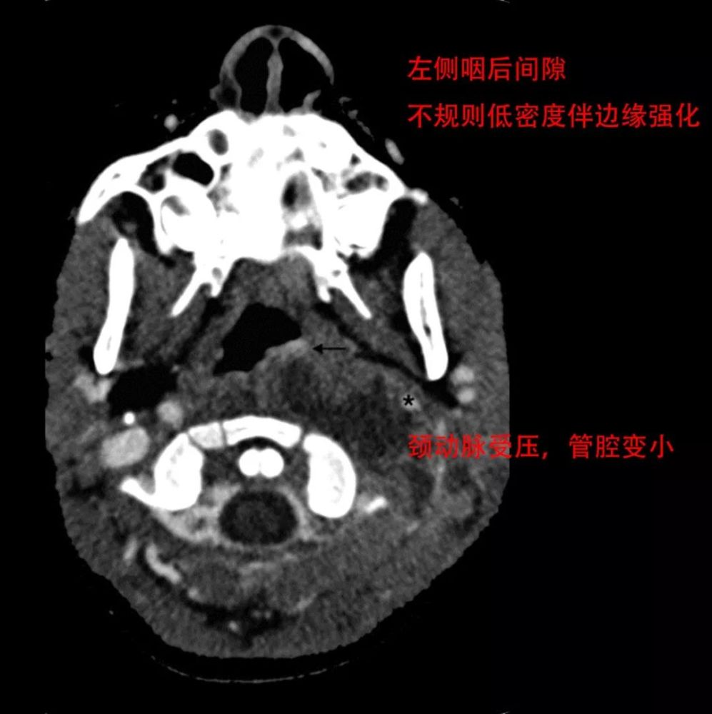 腮腺后隙综合征(villaret syndrome)= collet-sicard syndrome