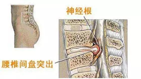 腰椎盘突出的7个误区别轻信其实这样预防才正确