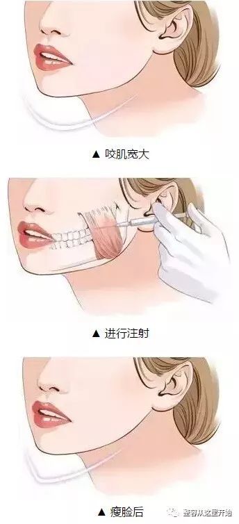 咬肌肥大应如何瘦脸?