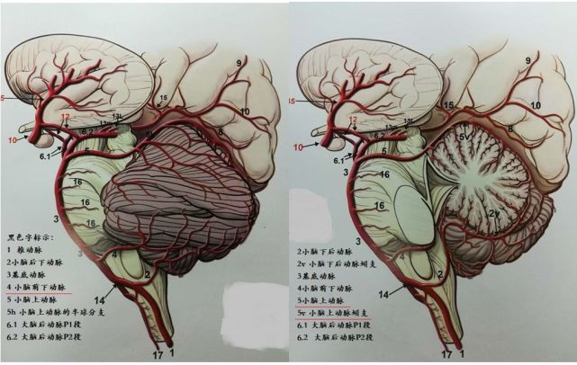 脑梗死,脑出血的定位诊断