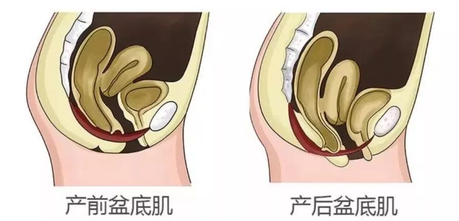 北京五洲妇儿医院专家讲:产后为什么一定要做盆底肌修复?