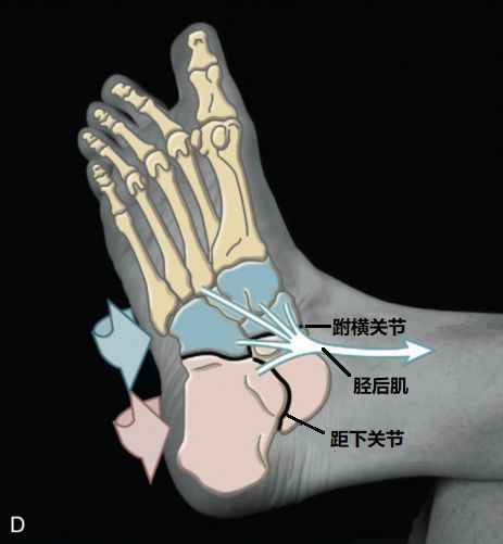 足底,足跟痛?小心足内翻!