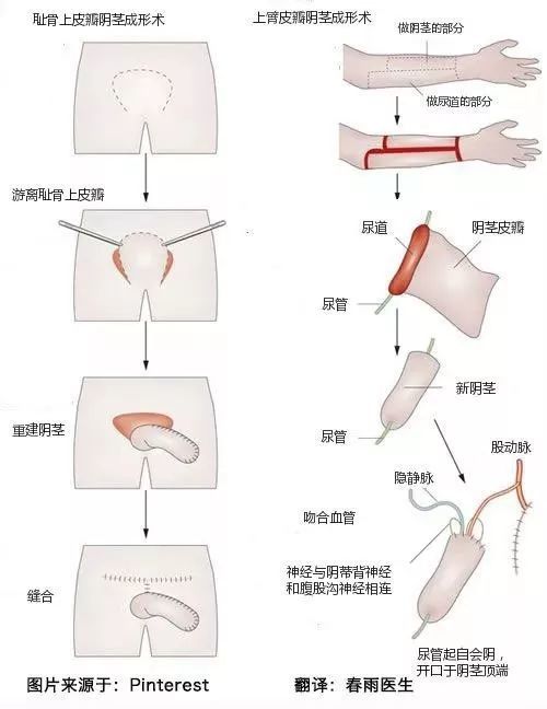 医学解密变性手术过程图示女变男