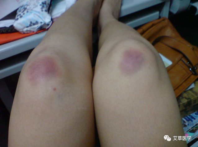 女人膝盖上的淤青你知道怎么回事吗