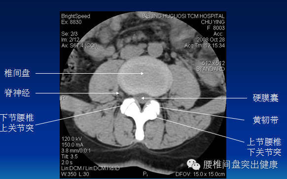 椎间盘膨出,突出,侧隐窝狭窄≤2mm,黄韧带肥厚>5mm,后纵韧带骨化