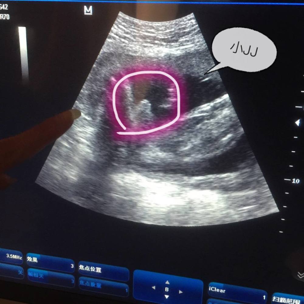 产妇做四维时,被医生老问"第一胎男孩女孩?"这到底什么意思?