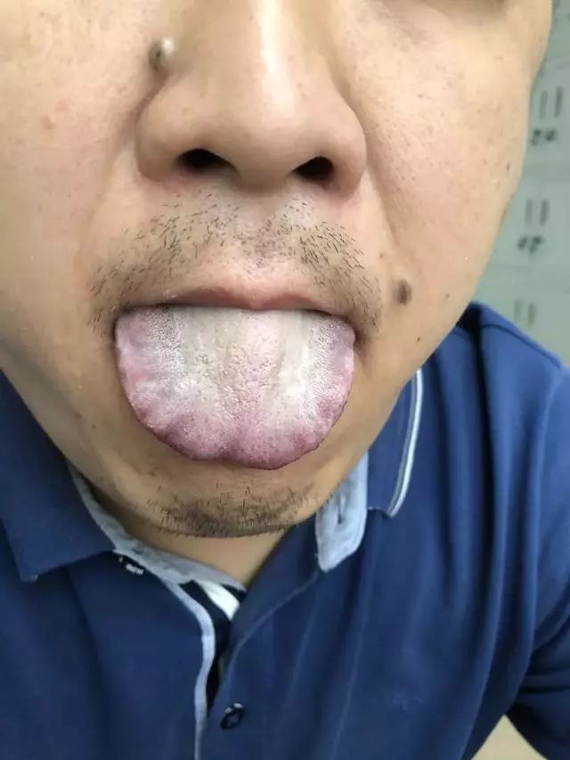 五 舌边瘀暗,齿痕明显,表示气虚血瘀,舌苔黄白相间,则是有湿热.