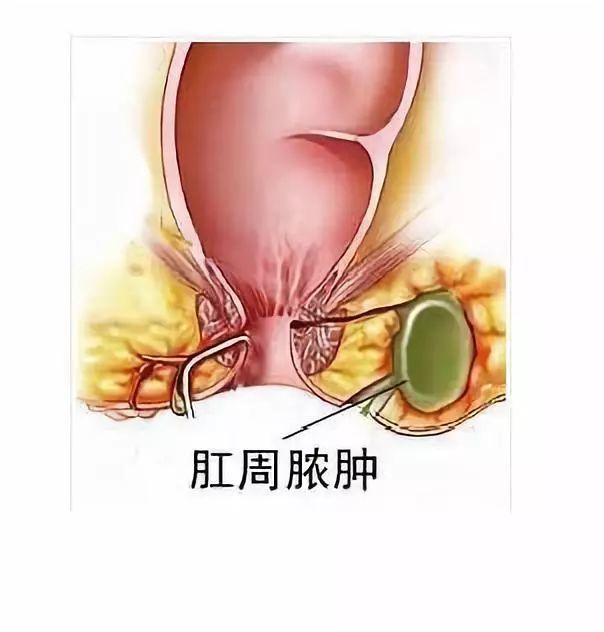 医源性因素:临床上属医源性引起的肛门直肠周围脓肿也不少见.