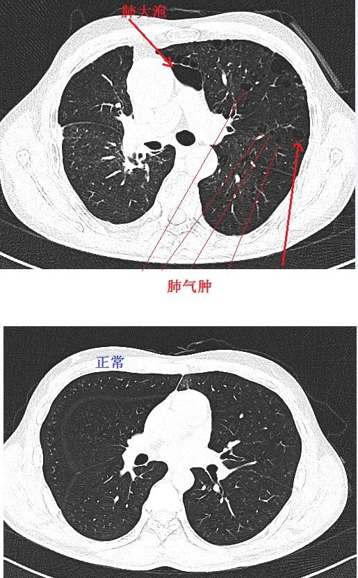 秒懂"肺气肿",赶紧收藏这些经典图谱!