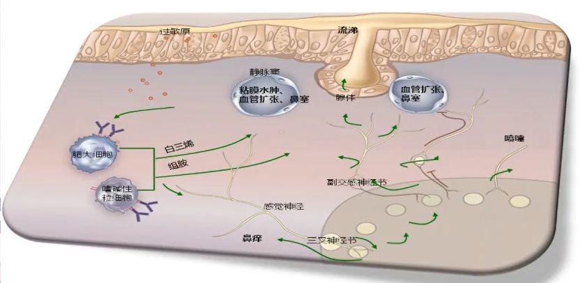 北大医学论坛如何诊治过敏性鼻炎