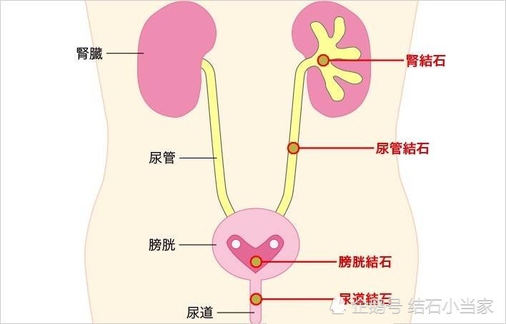 男性要这样预防肾结石,记住这四点很关键!