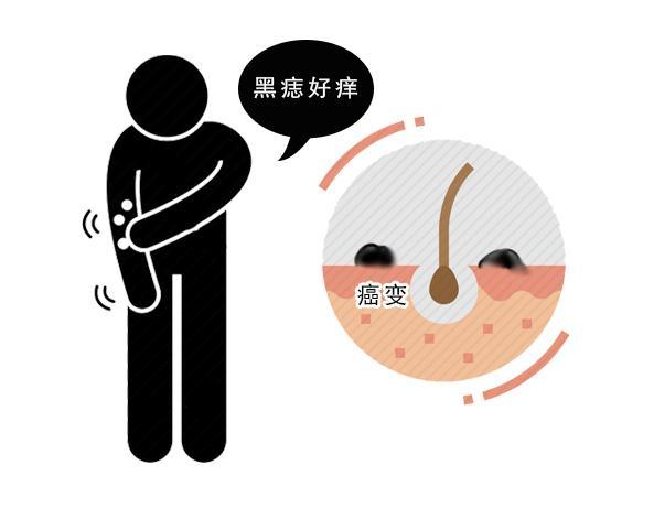 皮肤出现4种瘙痒,警惕癌细胞已上门