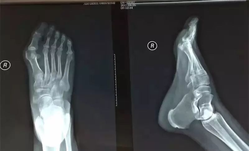 二跖趾关节滑膜炎 2 右第二跖趾关节错缝 3 右足胼胝 4 右足横弓塌陷