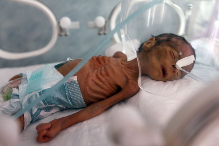 也门儿童瘦成皮包骨形似骷髅肋骨根根分明令人揪心