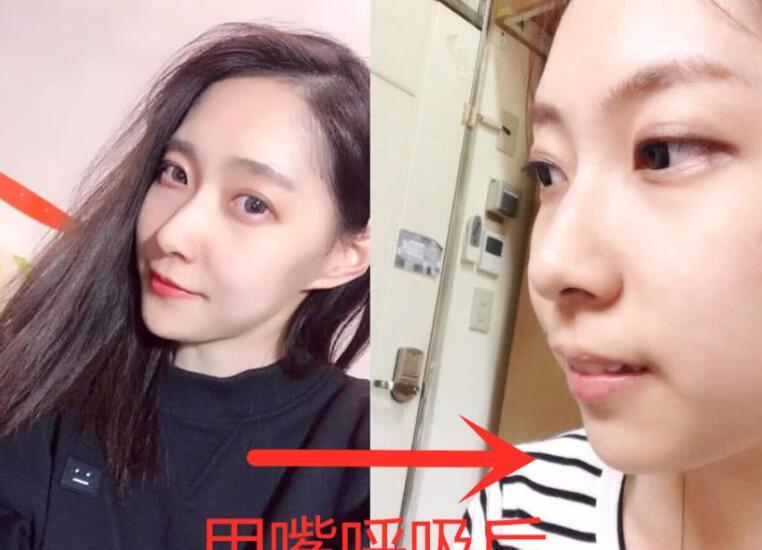 脸型会发生改变 长时间用嘴巴来呼吸会导致脸部发育不均衡,形成口呼吸
