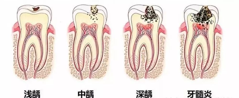 部分患者可以通过认真刷牙就能控制龋病进展,将龋